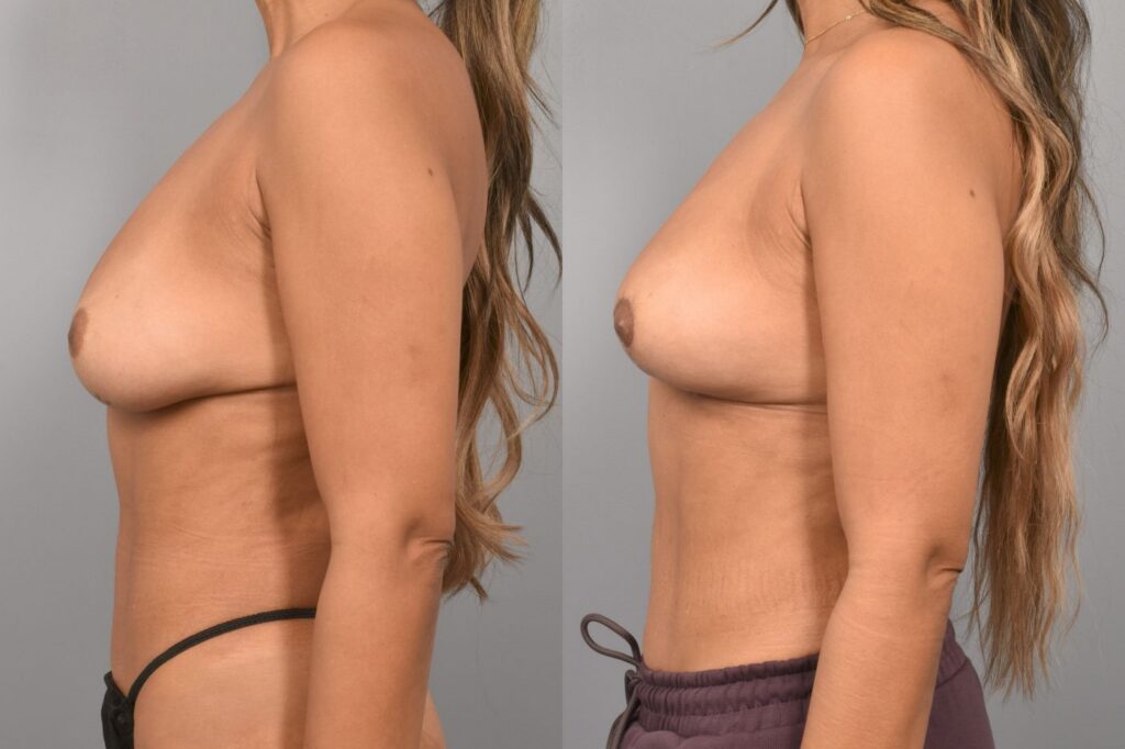 Side-by-side comparison of a female patient's left profile before and after breast lift by Dr. Bassiri-Tehrani. The left image shows her breast prior to surgery; the right image shows the same angle post-procedure
