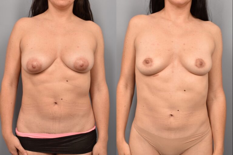 Side-by-side comparison of a female patient's straight-on view before and after breast lift by Dr. Bassiri-Tehrani. The left image shows her breast prior to surgery; the right image shows the same angle post-procedure