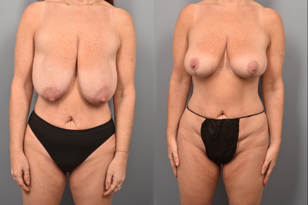Side-by-side comparison of a female patient's straight-on view before and after breast lift by Dr. Bassiri-Tehrani. The left image shows her breast prior to surgery; the right image shows the same angle post-procedure