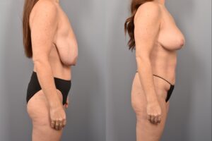 Side-by-side comparison of a female patient's right profile before and after breast lift by Dr. Bassiri-Tehrani. The left image shows her breast prior to surgery; the right image shows the same angle post-procedure